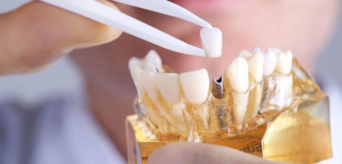 Tìm hiểu cấy ghép implant