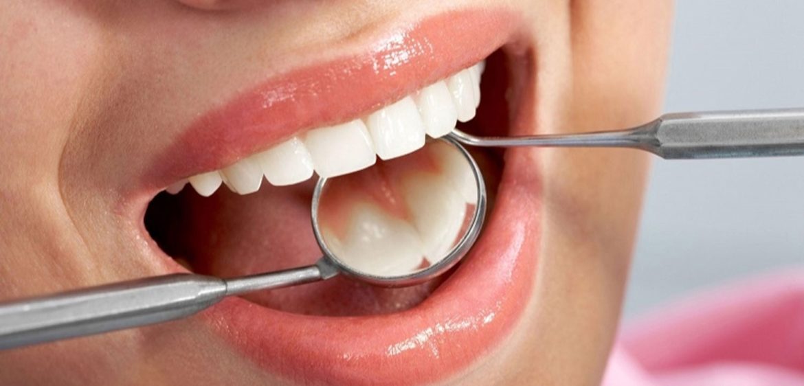 Lý do nên lấy cao răng định kỳ